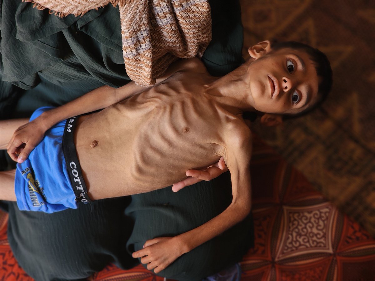 Gazze'de küçük Osama yaşam savaşı veriyor