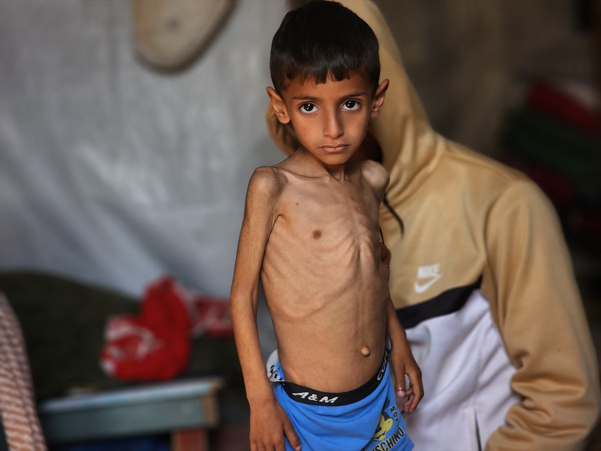 Gazze'de küçük Osama yaşam savaşı veriyor