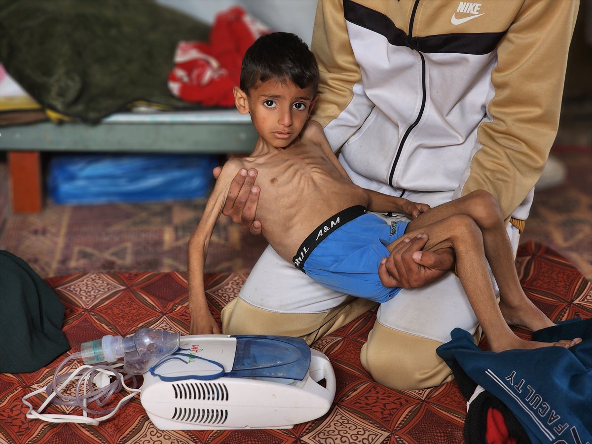 Gazze'de küçük Osama yaşam savaşı veriyor