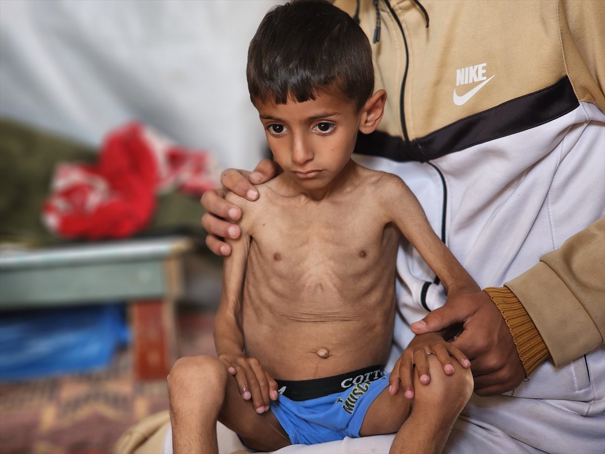 Gazze'de küçük Osama yaşam savaşı veriyor