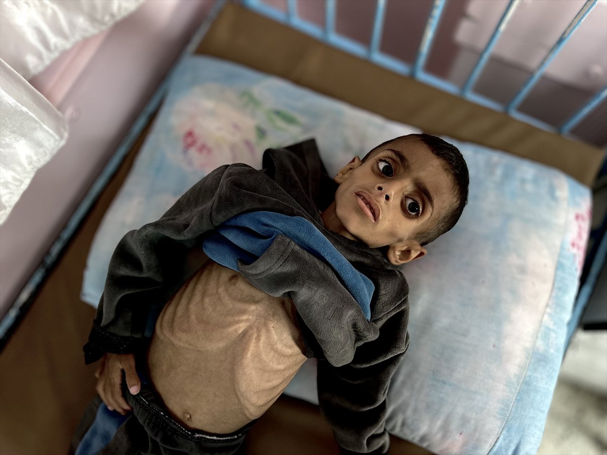 Gazze'de çocukların yetersiz beslenme vakaları giderek artıyor