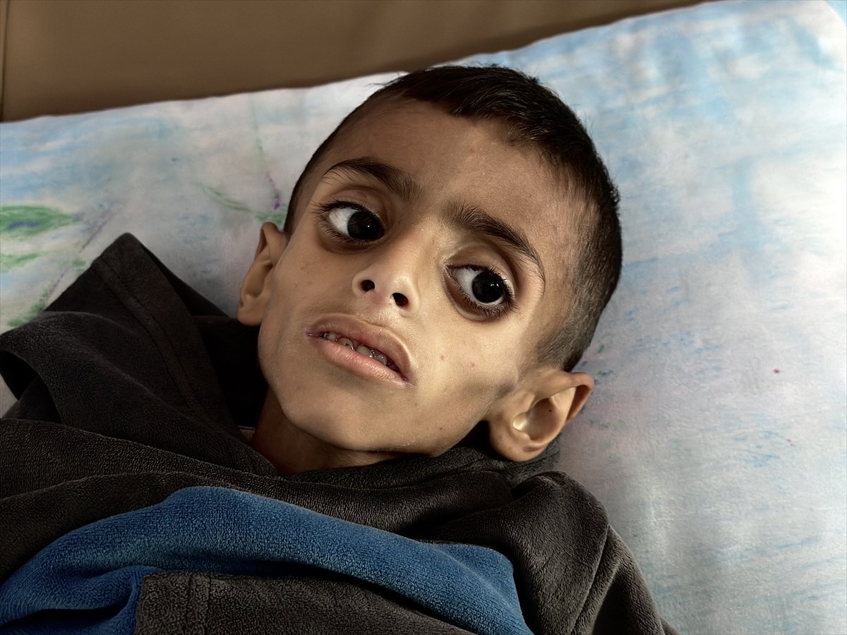 Gazze'de çocukların yetersiz beslenme vakaları giderek artıyor