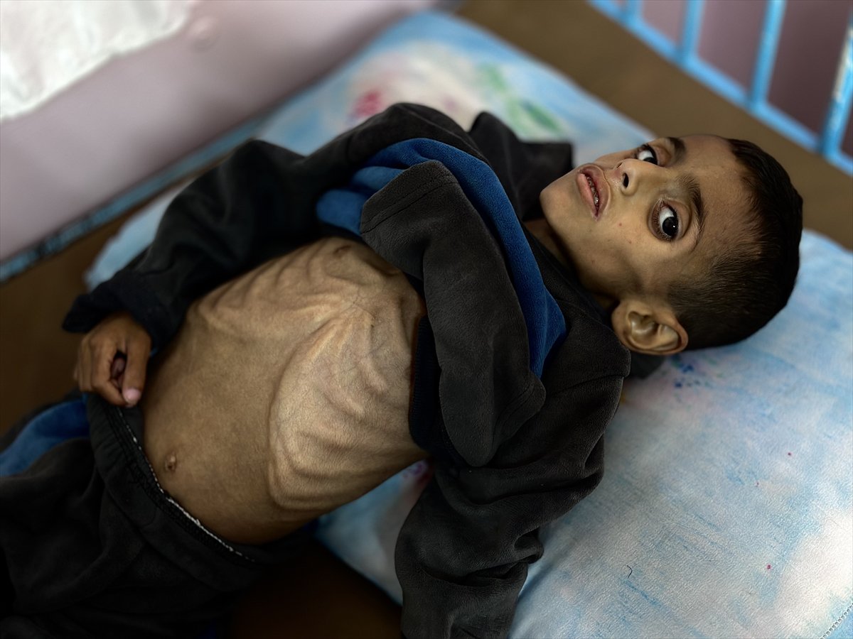 Gazze'de çocukların yetersiz beslenme vakaları giderek artıyor