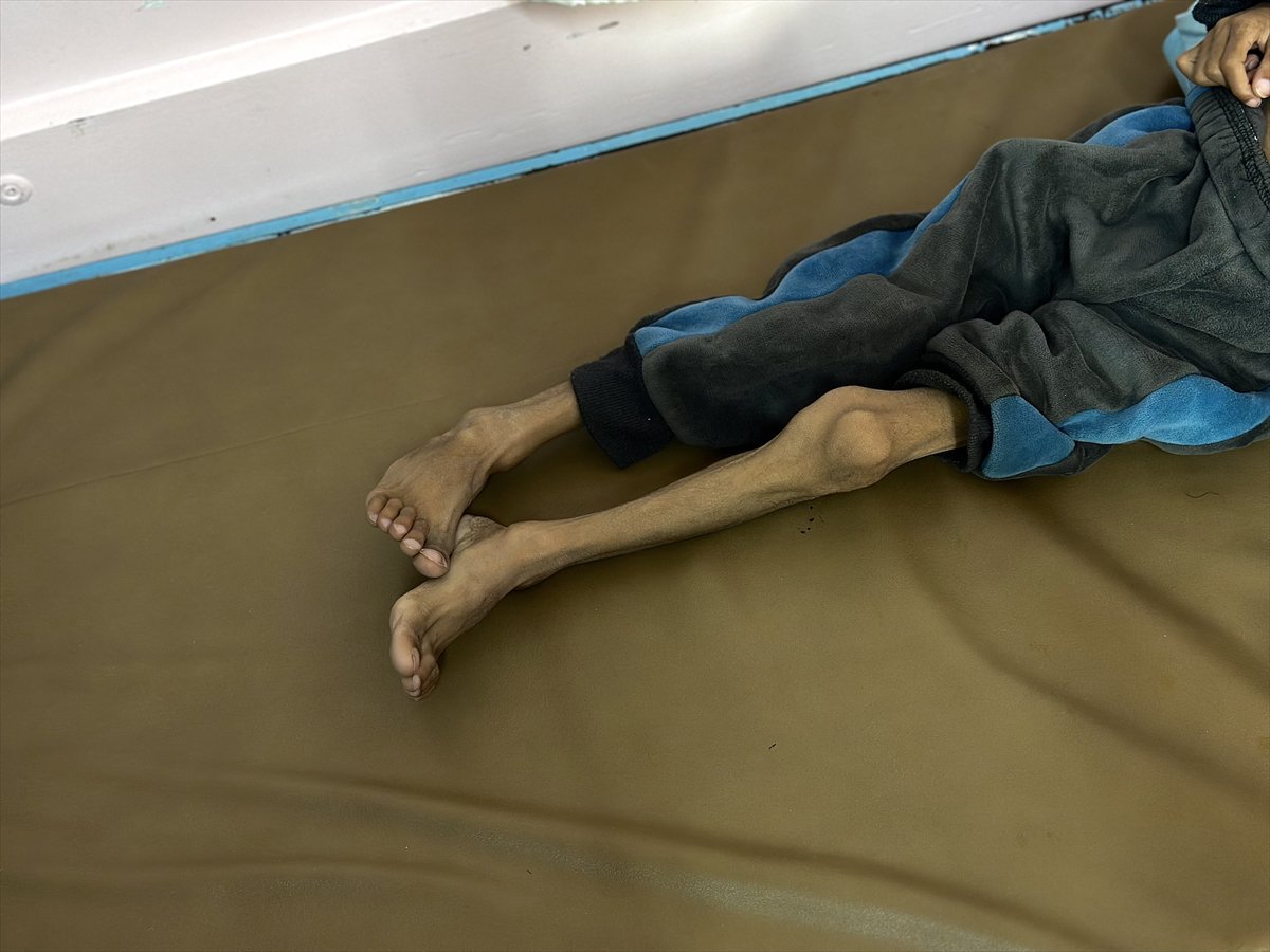 Gazze'de çocukların yetersiz beslenme vakaları giderek artıyor