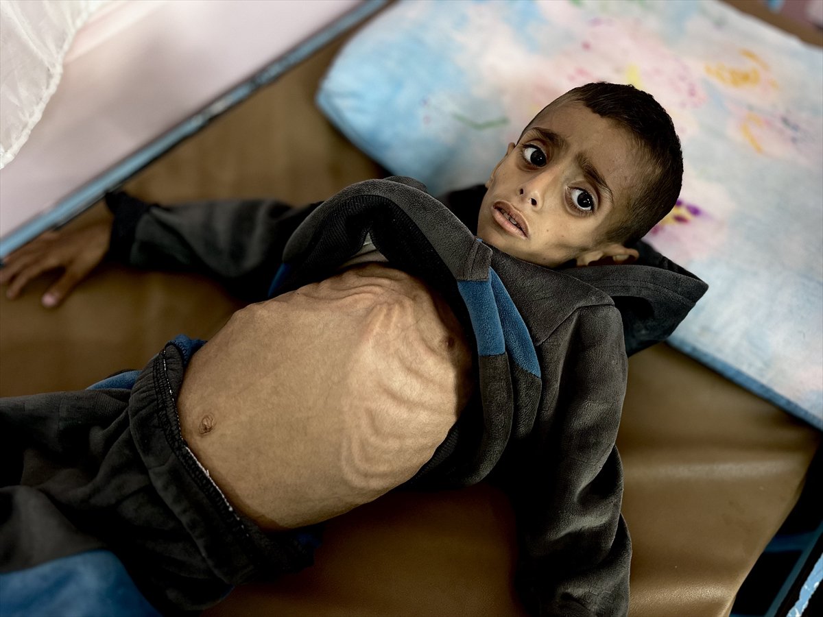 Gazze'de çocukların yetersiz beslenme vakaları giderek artıyor