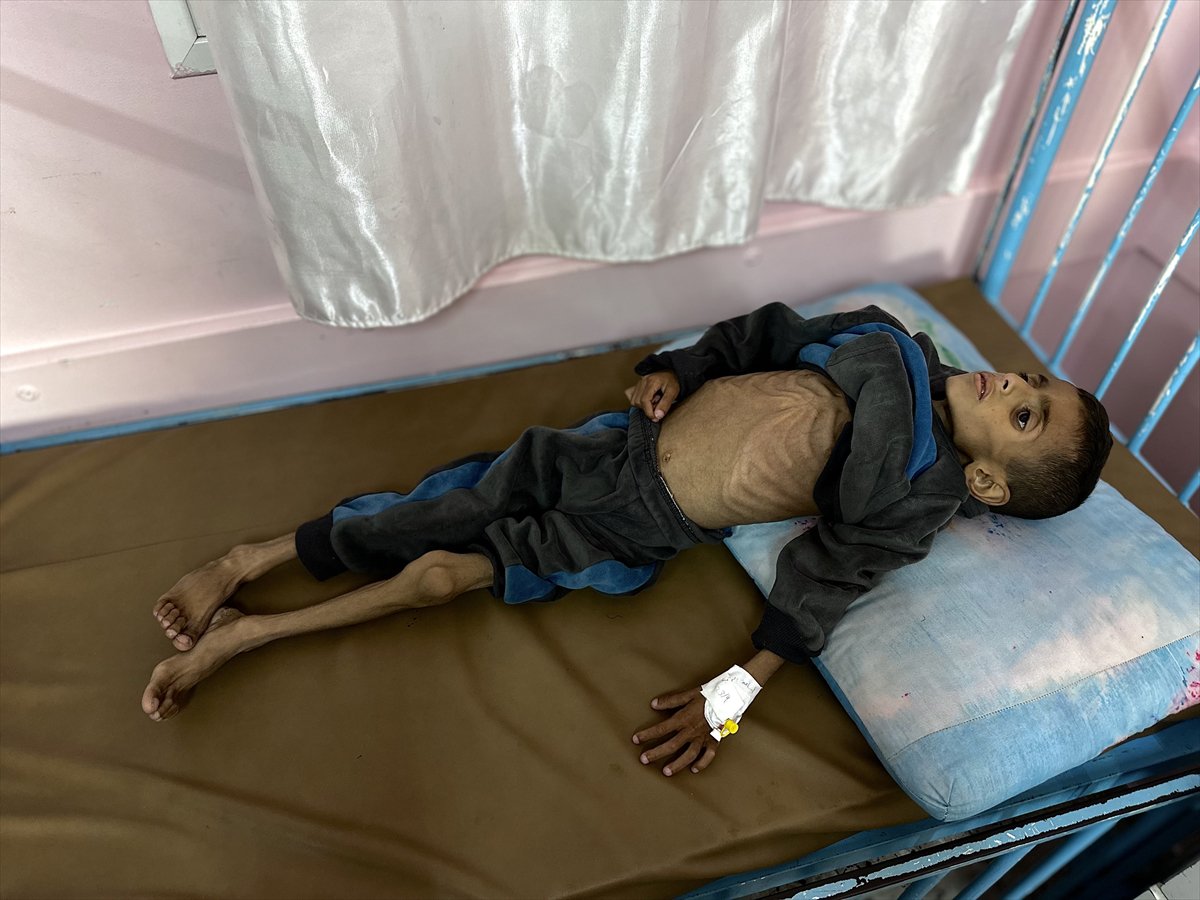 Gazze'de çocukların yetersiz beslenme vakaları giderek artıyor