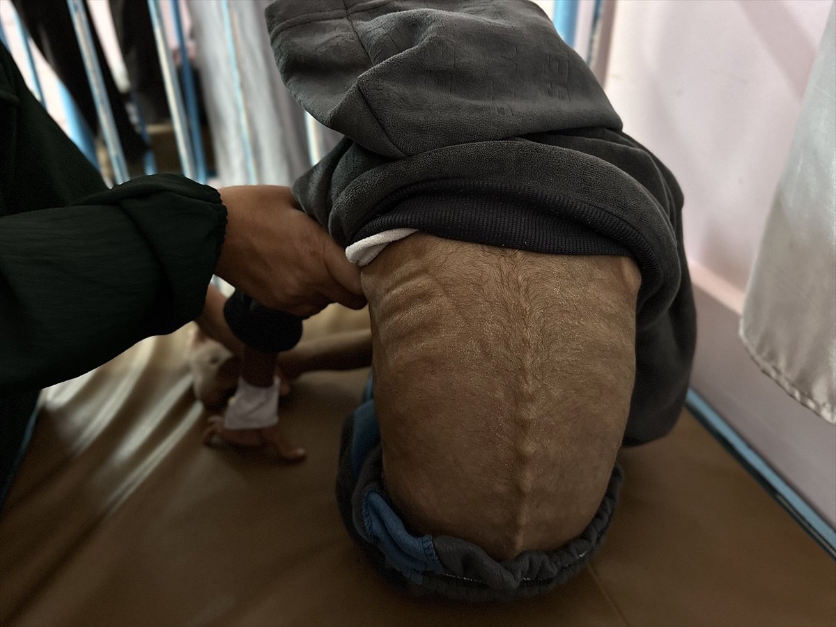 Gazze'de çocukların yetersiz beslenme vakaları giderek artıyor