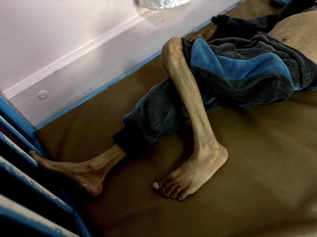 Gazze'de çocukların yetersiz beslenme vakaları giderek artıyor