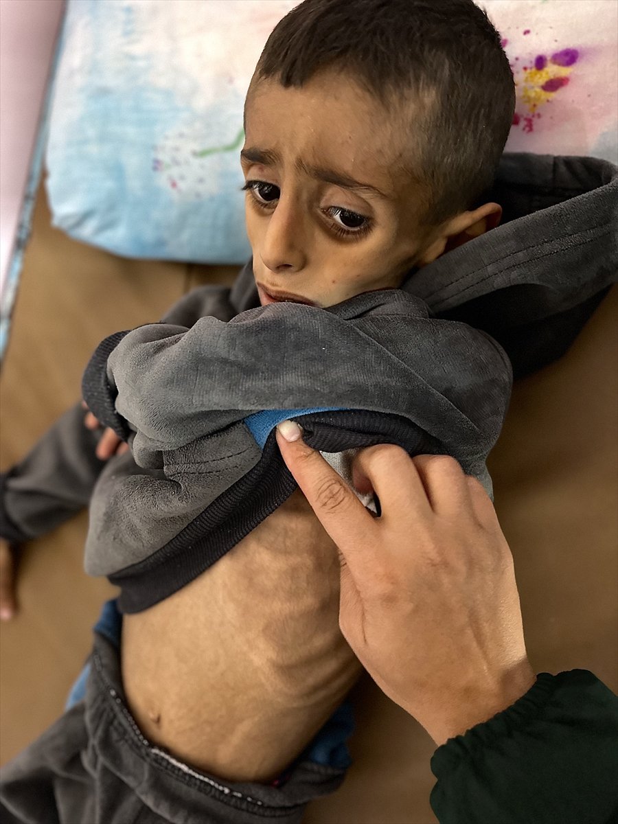 Gazze'de çocukların yetersiz beslenme vakaları giderek artıyor