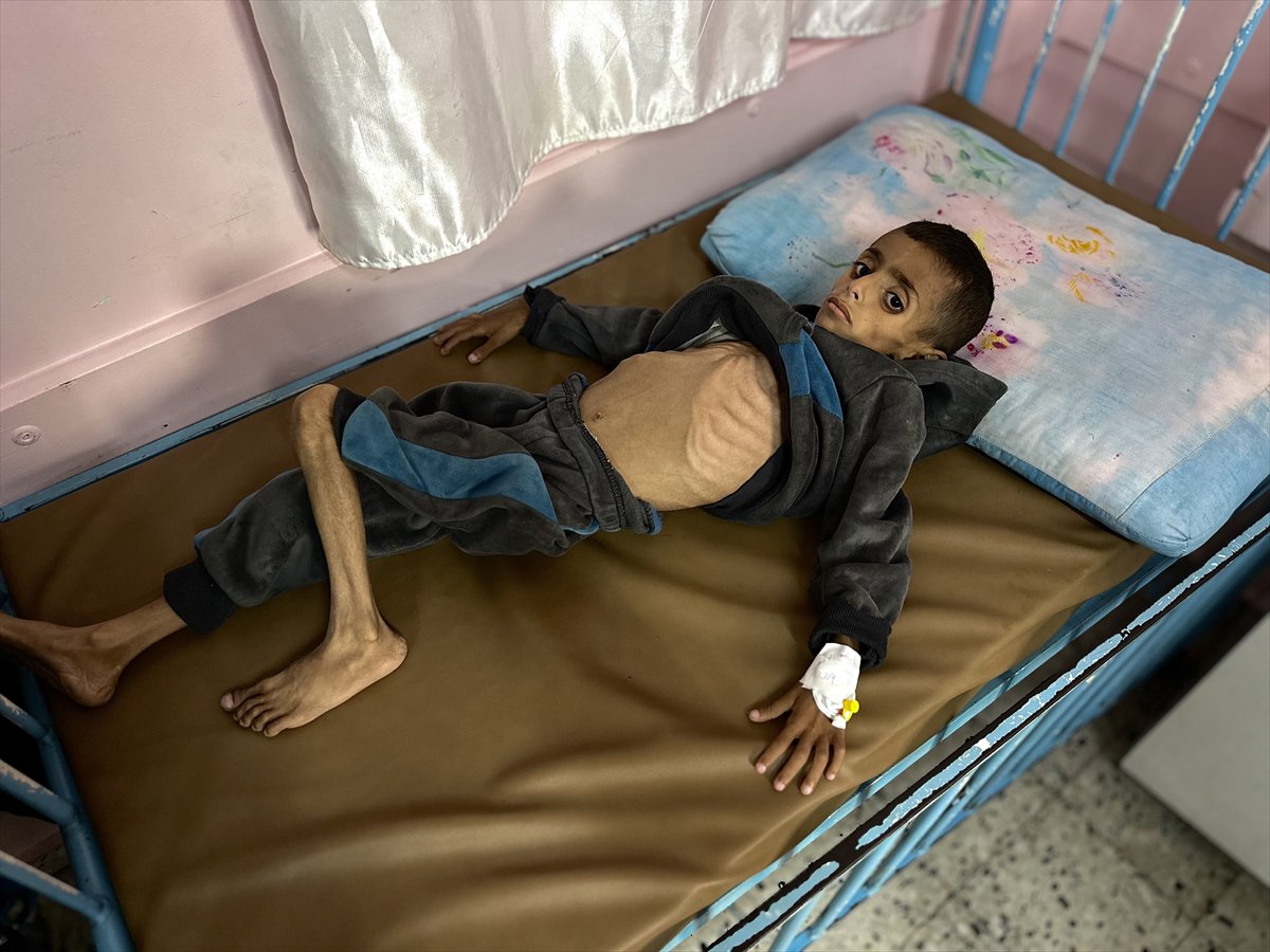 Gazze'de çocukların yetersiz beslenme vakaları giderek artıyor