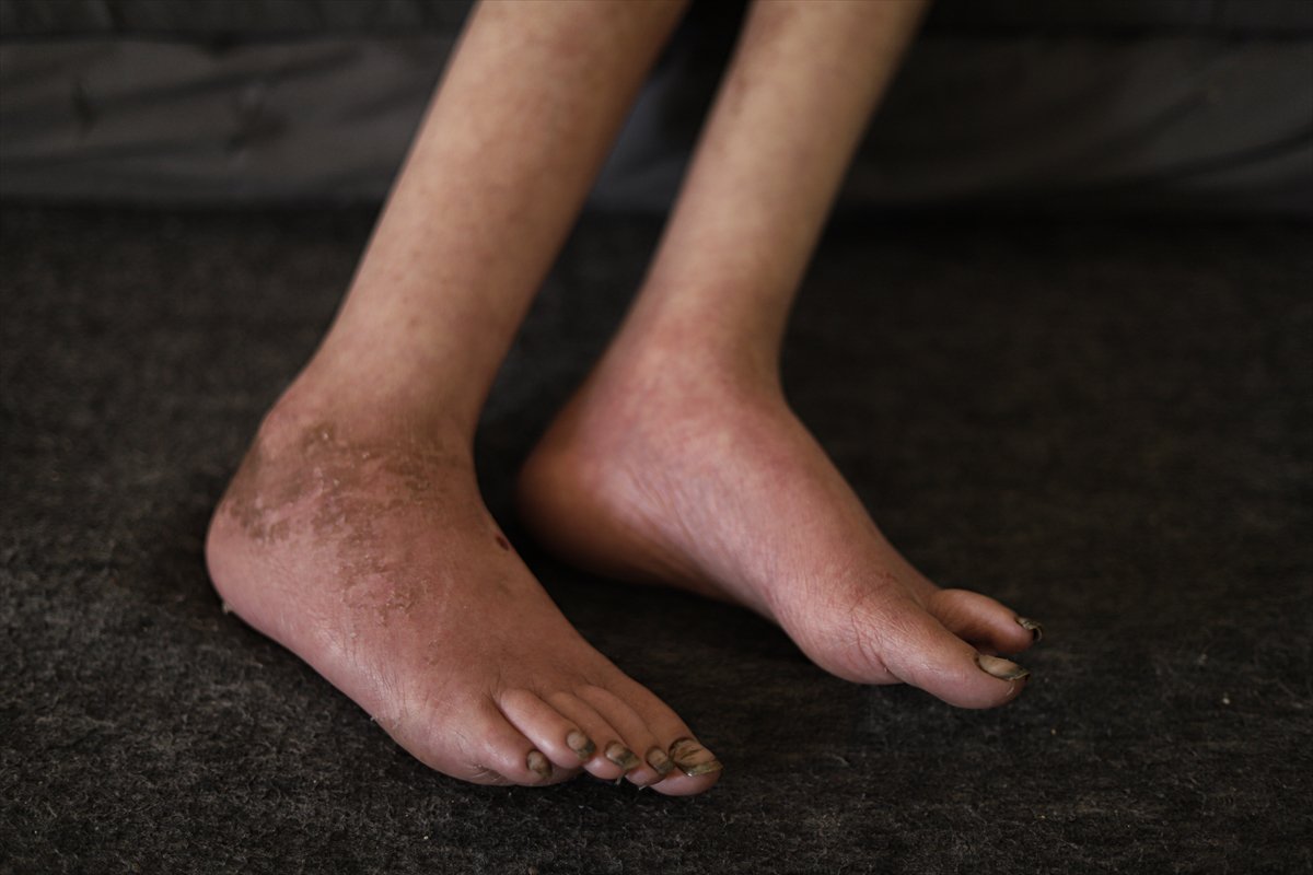 Gazze’de çocuklar, yetersiz beslenme nedeniyle hayatta kalma mücadelesi veriyor