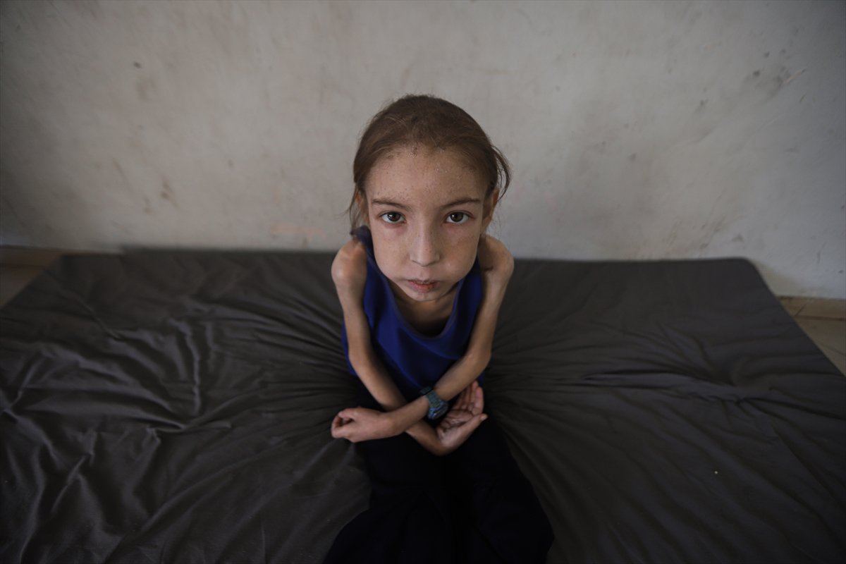 Gazze’de çocuklar, yetersiz beslenme nedeniyle hayatta kalma mücadelesi veriyor