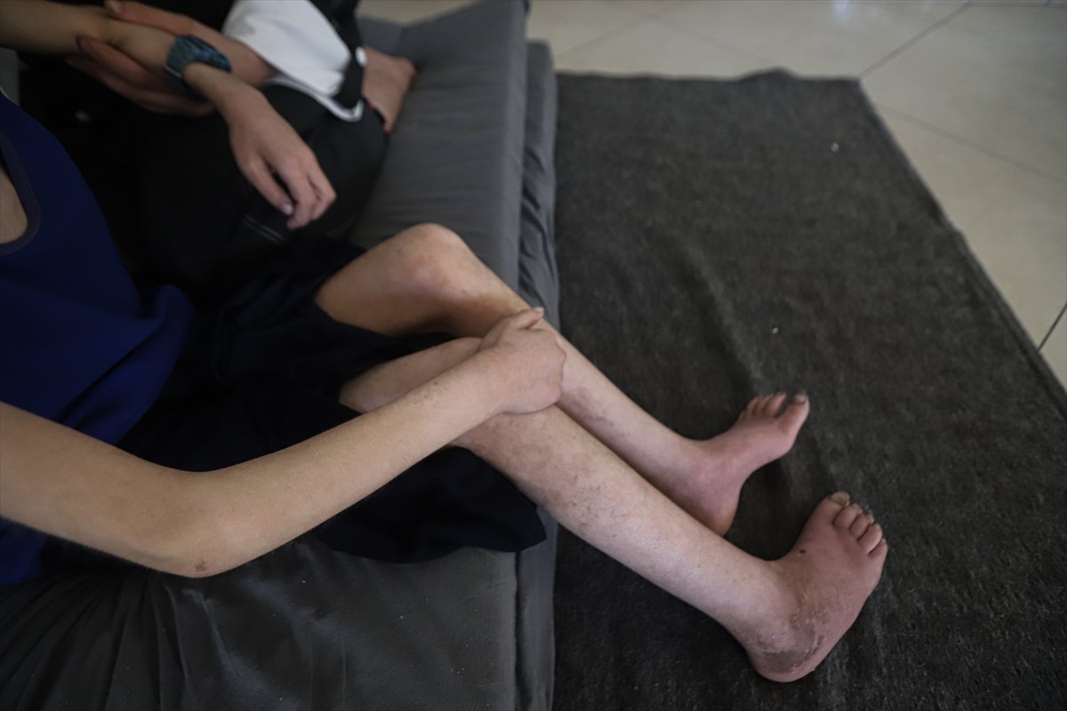 Gazze’de çocuklar, yetersiz beslenme nedeniyle hayatta kalma mücadelesi veriyor