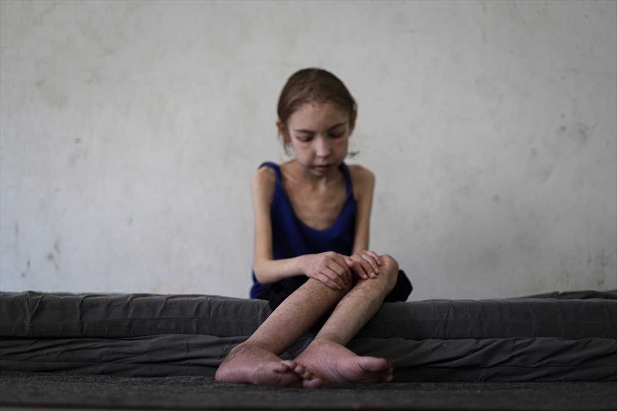 Gazze’de çocuklar, yetersiz beslenme nedeniyle hayatta kalma mücadelesi veriyor