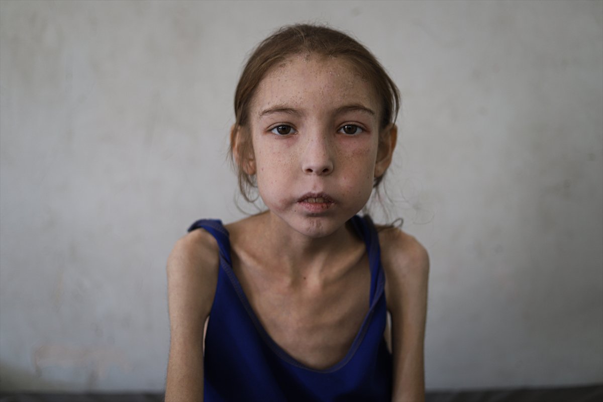 Gazze’de çocuklar, yetersiz beslenme nedeniyle hayatta kalma mücadelesi veriyor