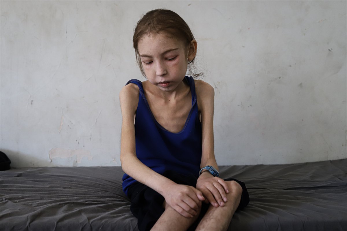 Gazze’de çocuklar, yetersiz beslenme nedeniyle hayatta kalma mücadelesi veriyor