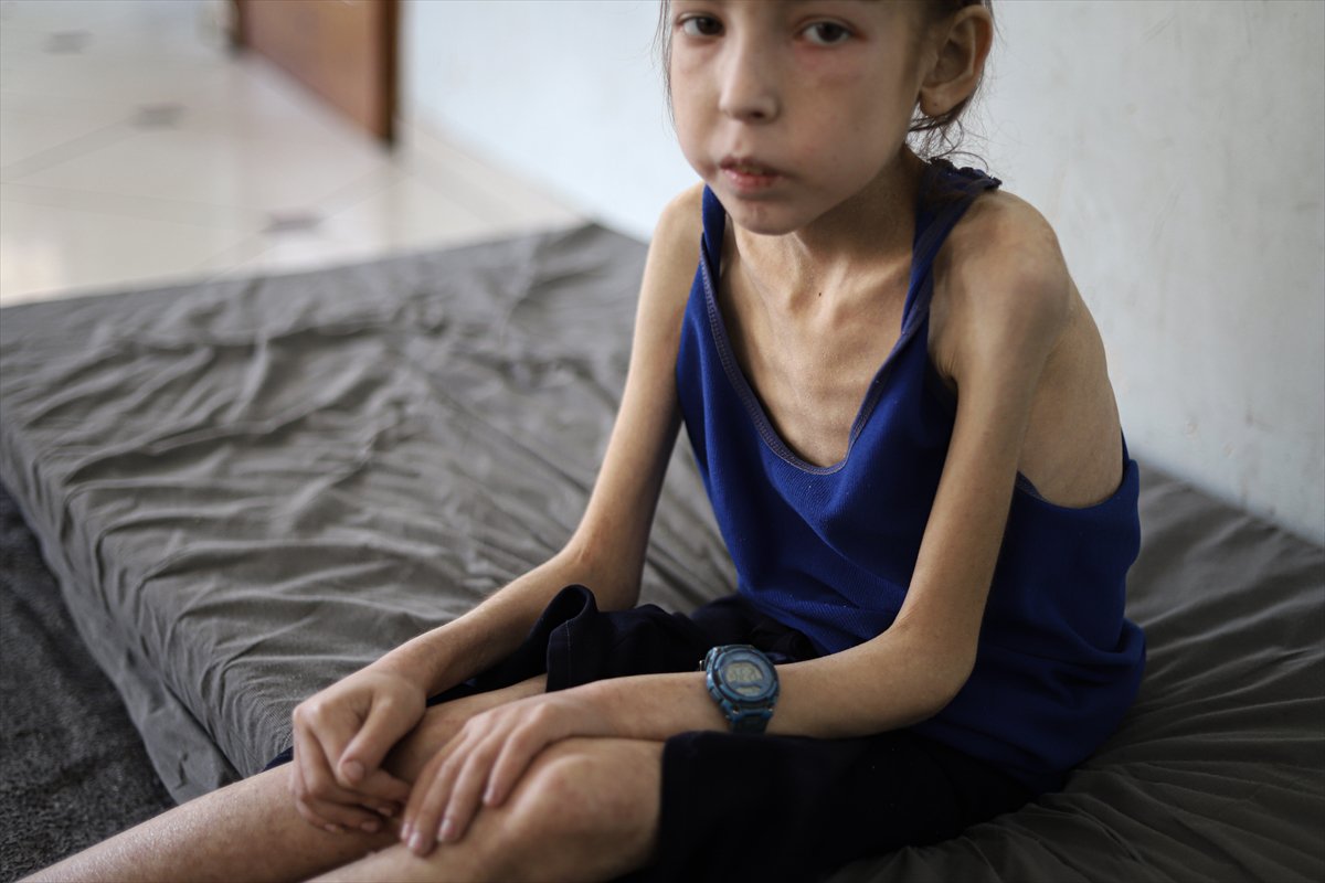 Gazze’de çocuklar, yetersiz beslenme nedeniyle hayatta kalma mücadelesi veriyor