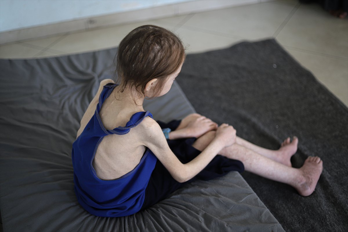 Gazze’de çocuklar, yetersiz beslenme nedeniyle hayatta kalma mücadelesi veriyor