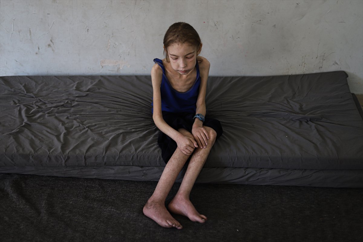 Gazze’de çocuklar, yetersiz beslenme nedeniyle hayatta kalma mücadelesi veriyor