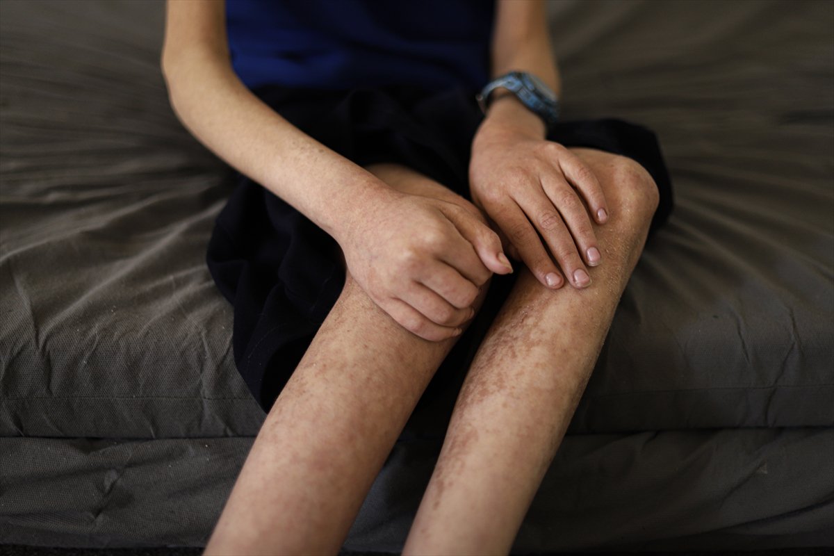 Gazze’de çocuklar, yetersiz beslenme nedeniyle hayatta kalma mücadelesi veriyor