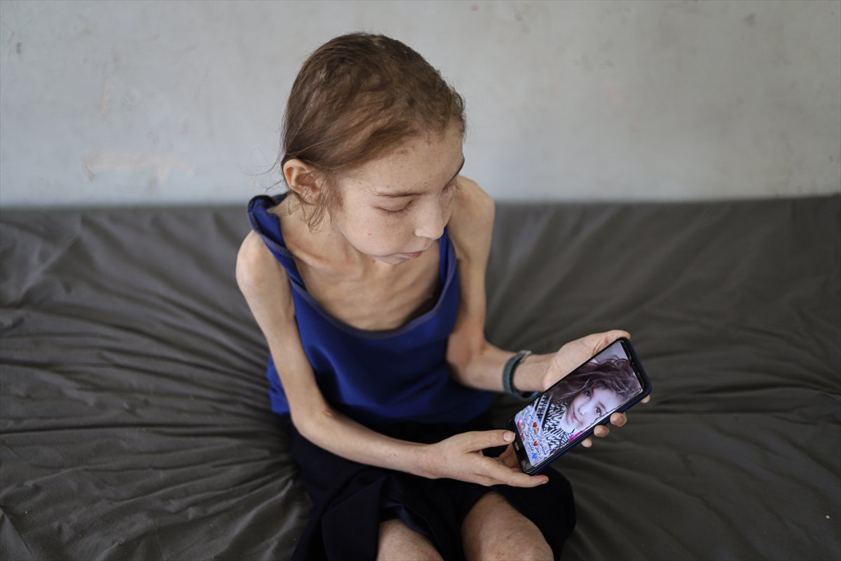 Gazze’de çocuklar, yetersiz beslenme nedeniyle hayatta kalma mücadelesi veriyor