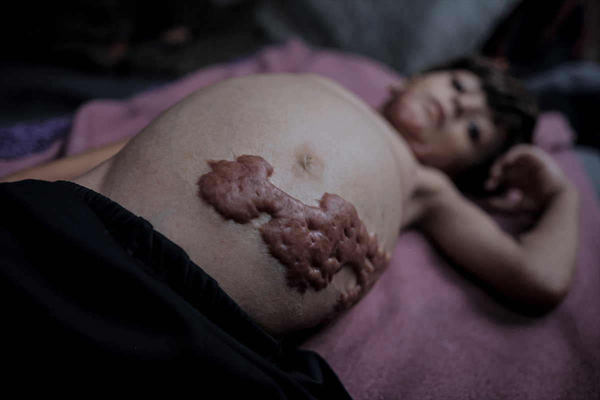 İsrail saldırısının hedefi olan çocuklardan biri: Muhammed