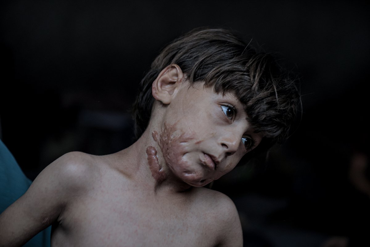 İsrail saldırısının hedefi olan çocuklardan biri: Muhammed