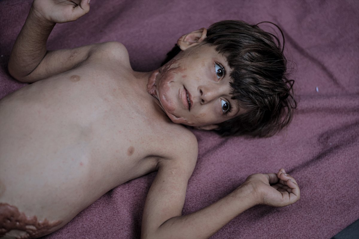 İsrail saldırısının hedefi olan çocuklardan biri: Muhammed