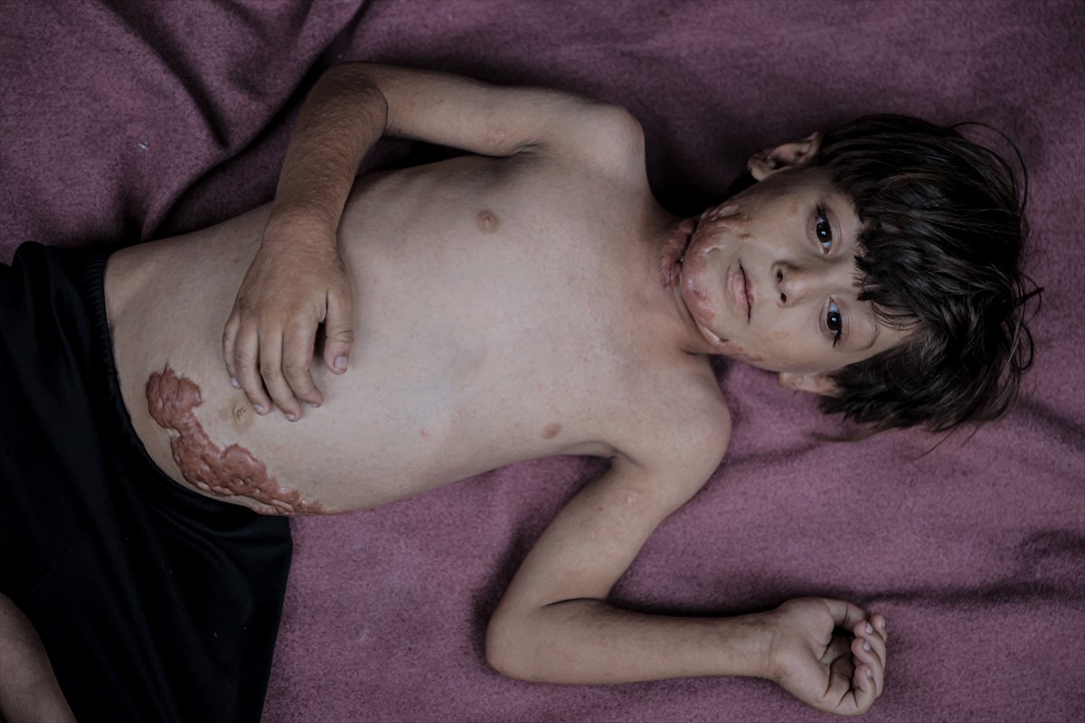 İsrail saldırısının hedefi olan çocuklardan biri: Muhammed