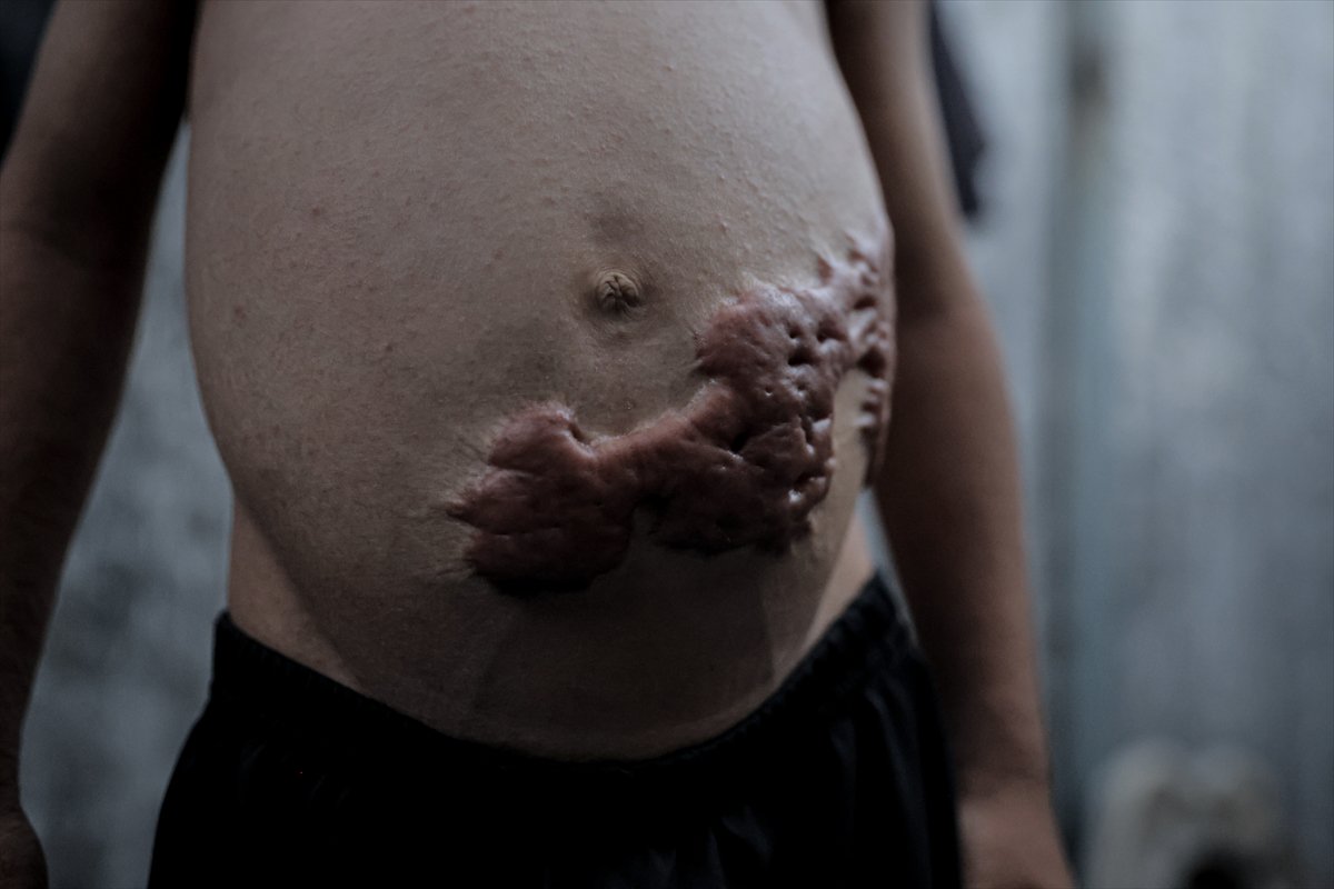 İsrail saldırısının hedefi olan çocuklardan biri: Muhammed