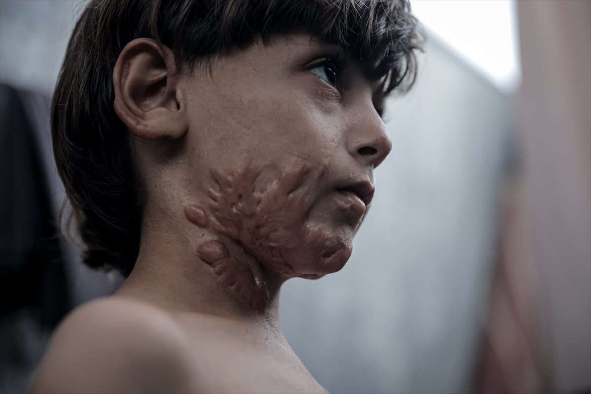 İsrail saldırısının hedefi olan çocuklardan biri: Muhammed