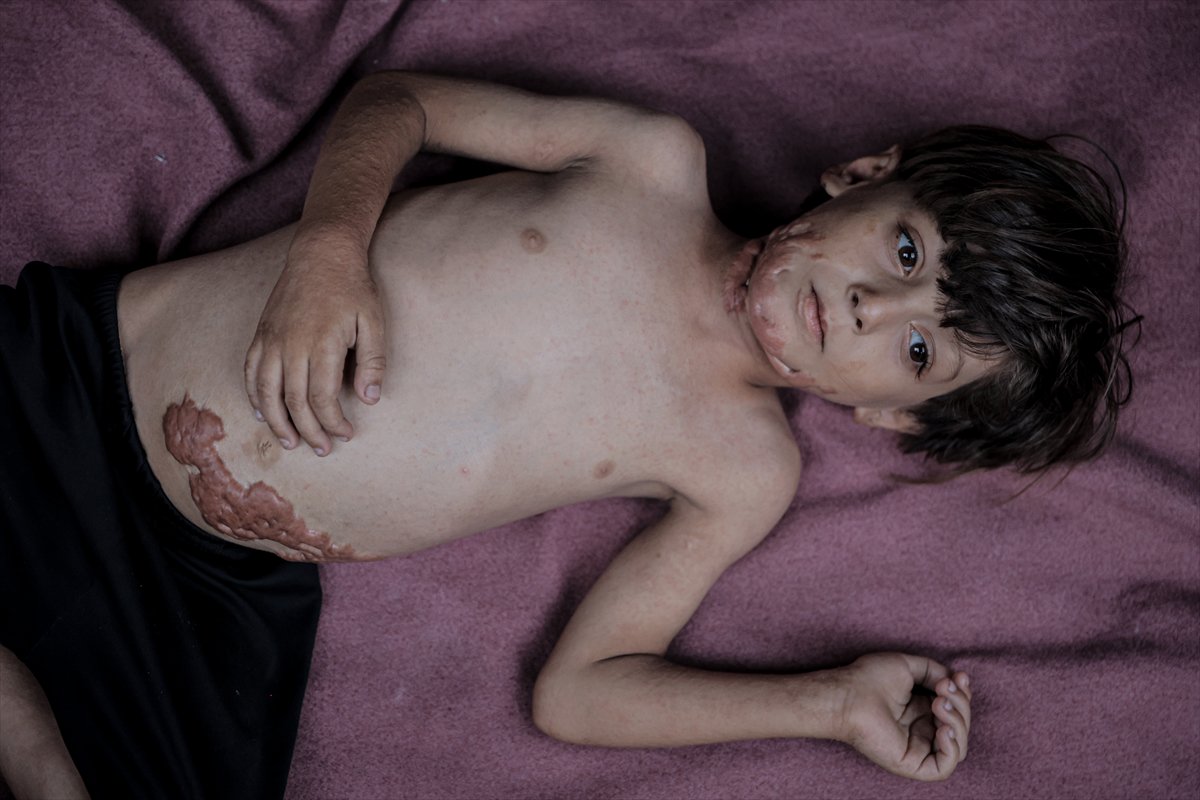 İsrail saldırısının hedefi olan çocuklardan biri: Muhammed