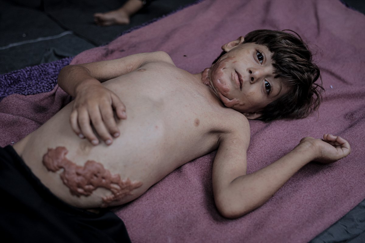 İsrail saldırısının hedefi olan çocuklardan biri: Muhammed