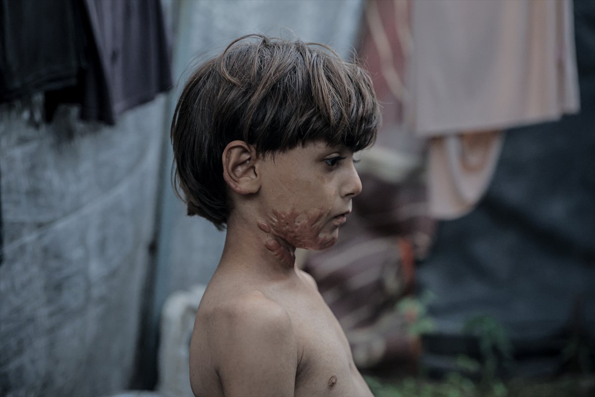 İsrail saldırısının hedefi olan çocuklardan biri: Muhammed