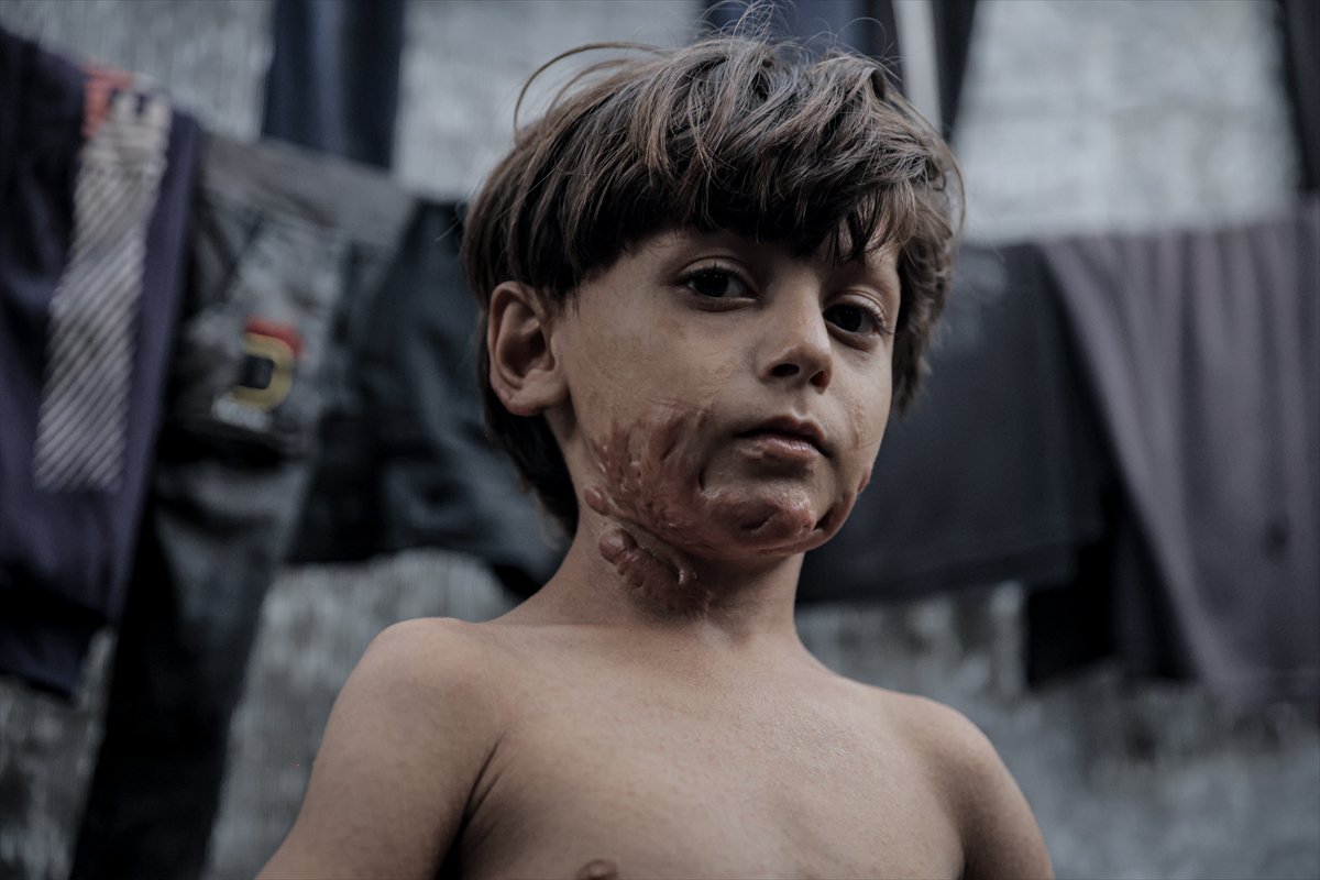 İsrail saldırısının hedefi olan çocuklardan biri: Muhammed