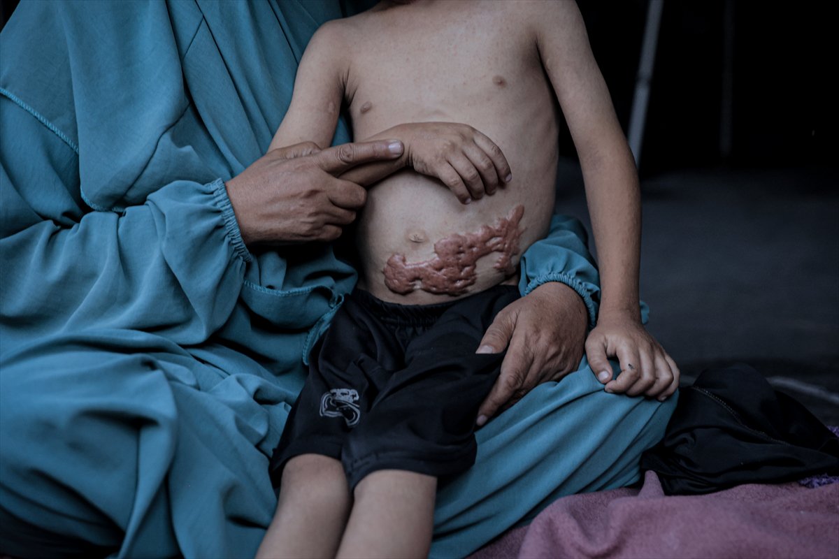 İsrail saldırısının hedefi olan çocuklardan biri: Muhammed