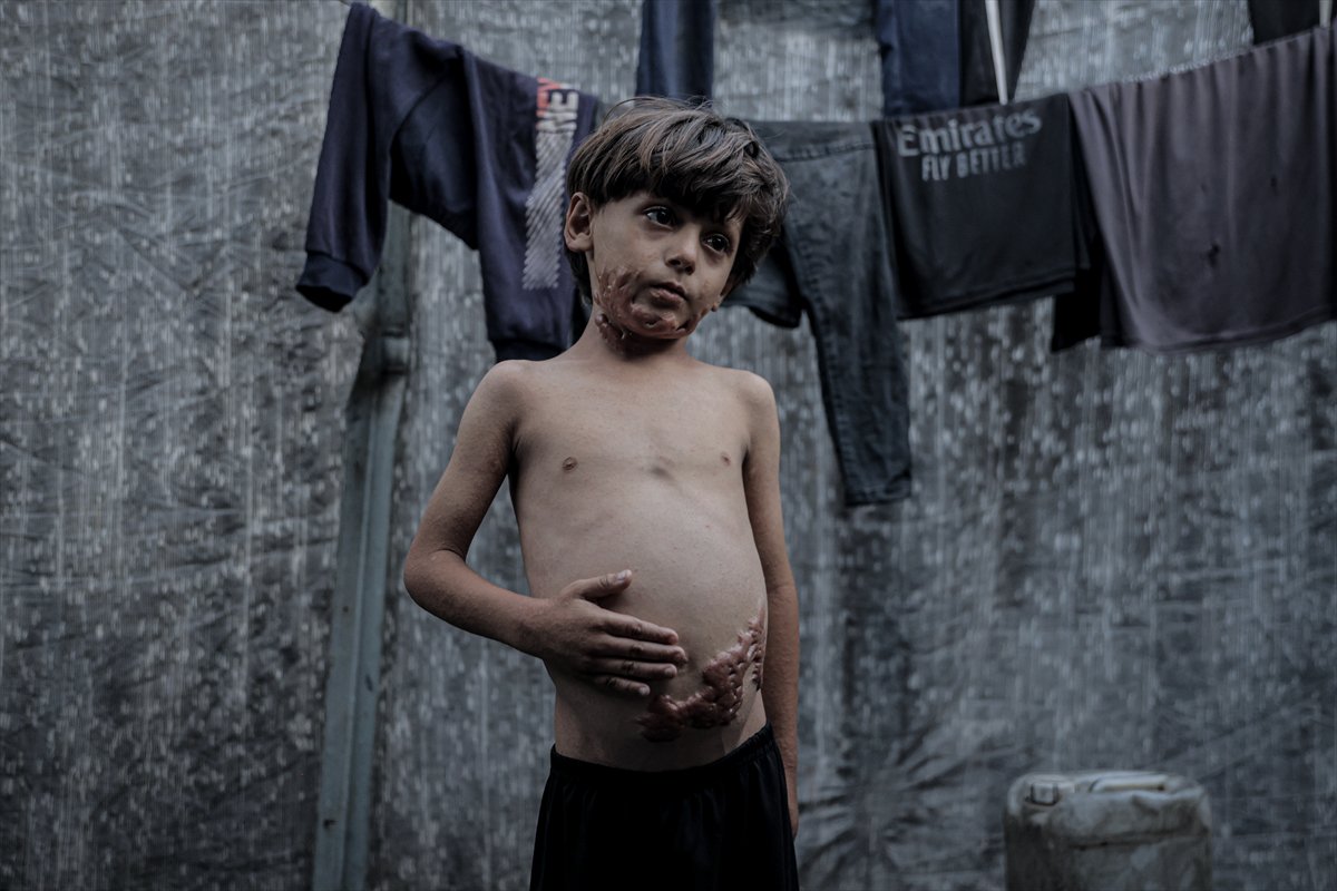 İsrail saldırısının hedefi olan çocuklardan biri: Muhammed