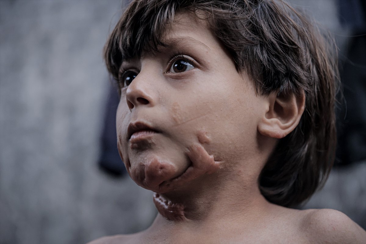 İsrail saldırısının hedefi olan çocuklardan biri: Muhammed