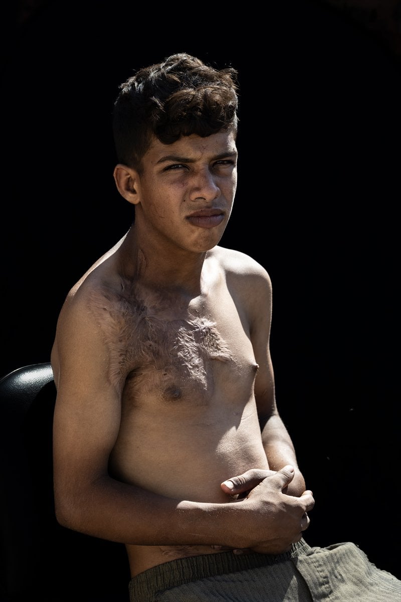 Gazze'de binlerce çocuk İsrail saldırılarında uzuvlarını kaybetti