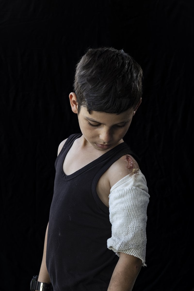 Gazze'de binlerce çocuk İsrail saldırılarında uzuvlarını kaybetti