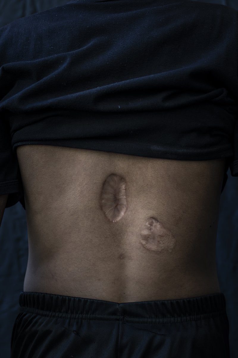 Gazze'de binlerce çocuk İsrail saldırılarında uzuvlarını kaybetti