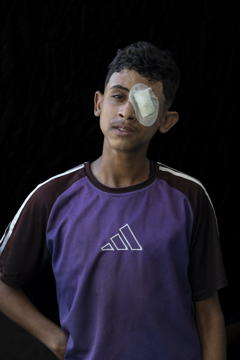 Gazze'de binlerce çocuk İsrail saldırılarında uzuvlarını kaybetti