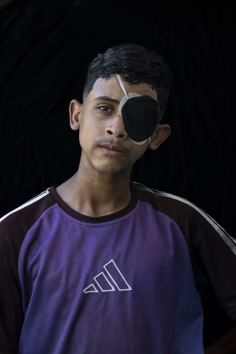 Gazze'de binlerce çocuk İsrail saldırılarında uzuvlarını kaybetti