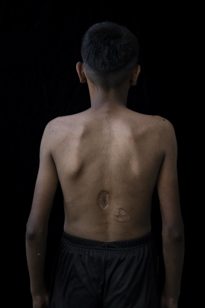 Gazze'de binlerce çocuk İsrail saldırılarında uzuvlarını kaybetti