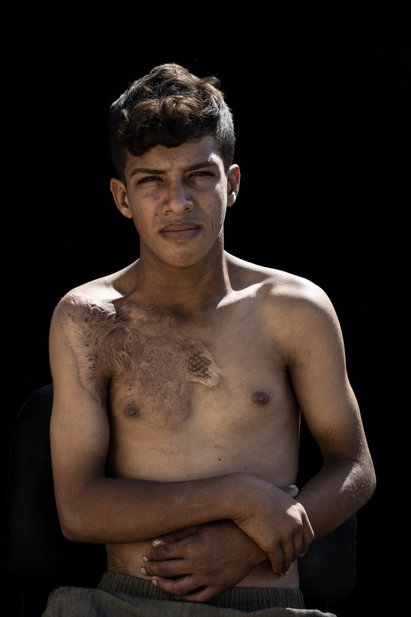 Gazze'de binlerce çocuk İsrail saldırılarında uzuvlarını kaybetti