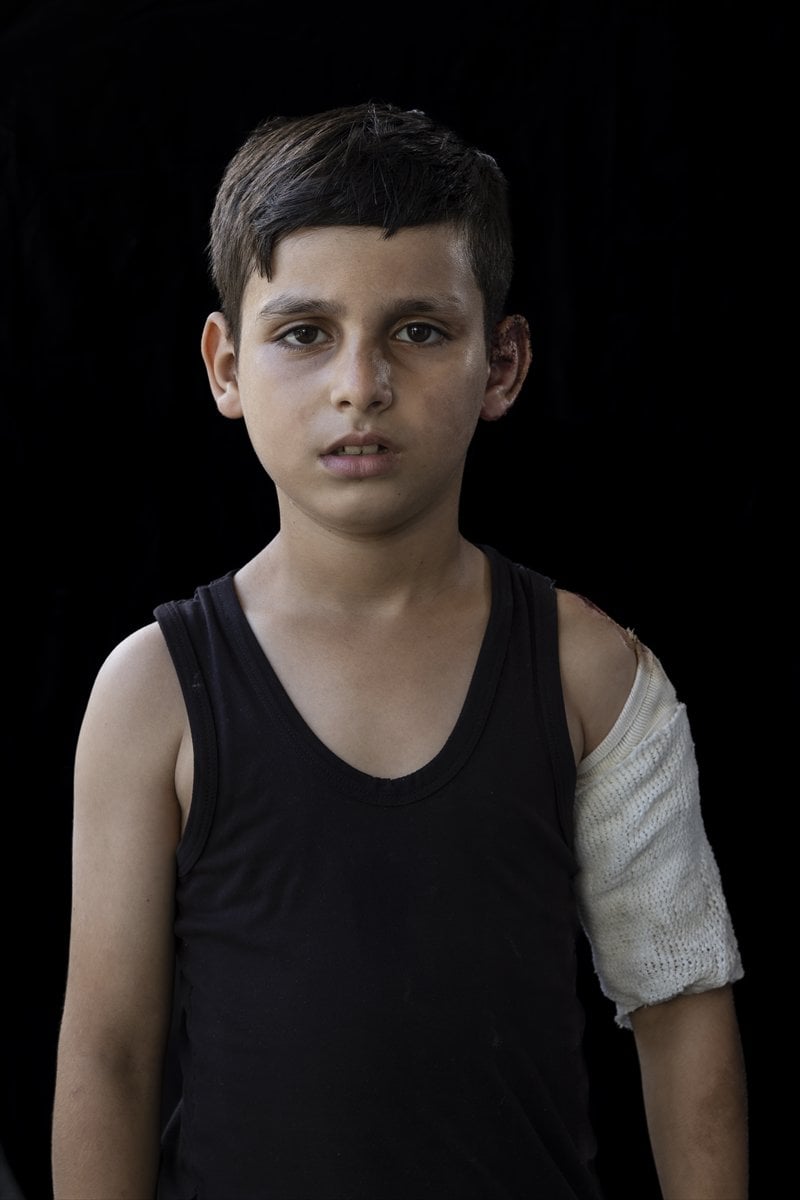 Gazze'de binlerce çocuk İsrail saldırılarında uzuvlarını kaybetti