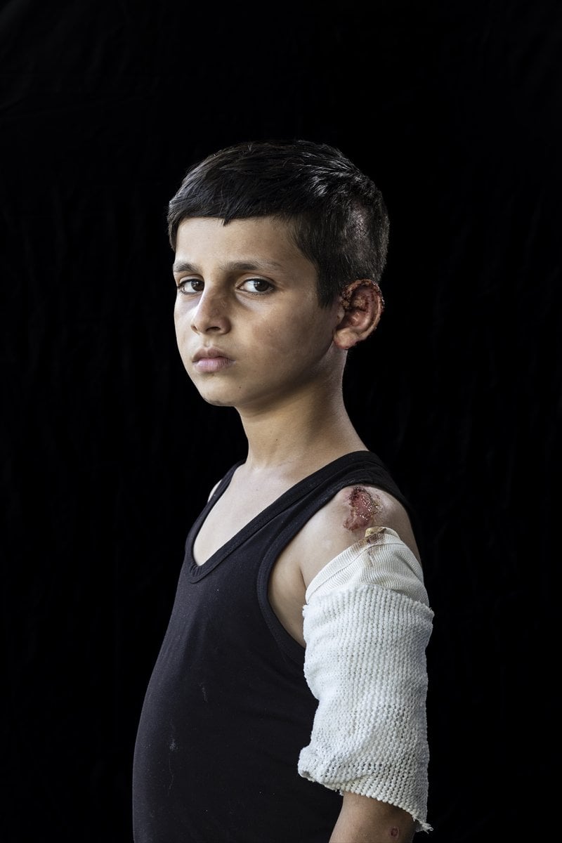 Gazze'de binlerce çocuk İsrail saldırılarında uzuvlarını kaybetti