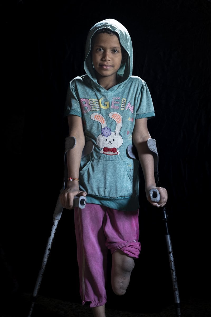 Gazze'de binlerce çocuk İsrail saldırılarında uzuvlarını kaybetti