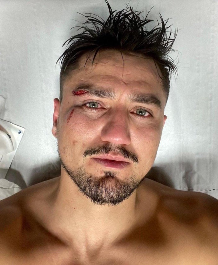 Montpellier maçında kaşı açılan Cengiz Ünder son durumunu paylaştı