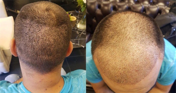 Geçtiğimiz yıl 1 milyon kişi Türkiye'ye saç ektirmeye geldi